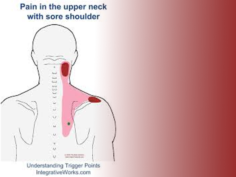 The Effectiveness of Cupping Therapy on Relieving Chronic Neck and Shoulder Pain: A Randomized Controlled Trial