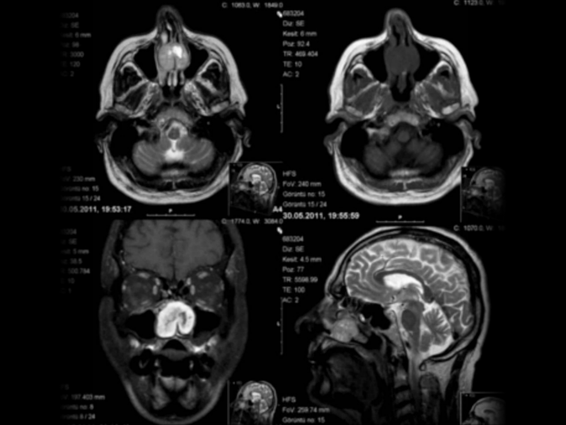 Chronic headache and migraine: An Integrated Approach.